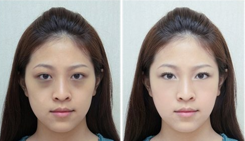 黑眼圈如何才能去除呢？